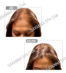 мезотерапія для волосся